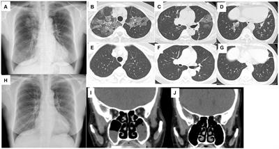 Tezepelumab improved chronic eosinophilic pneumonia in severe asthma patients with liver cirrhosis